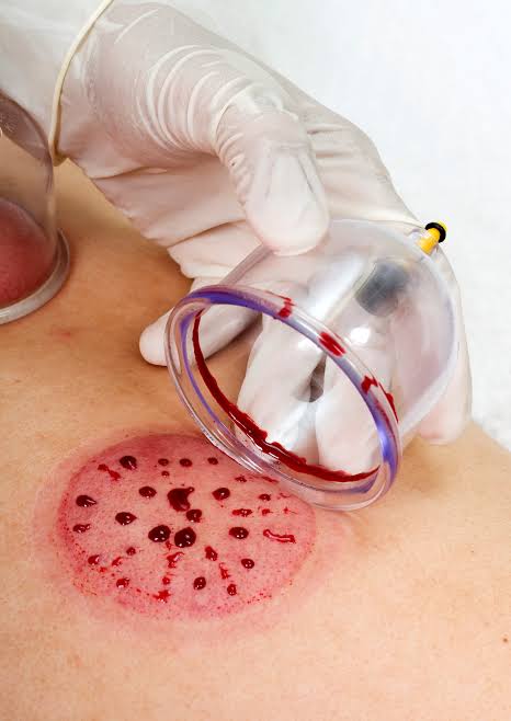 الحجامة بتيسمسلت