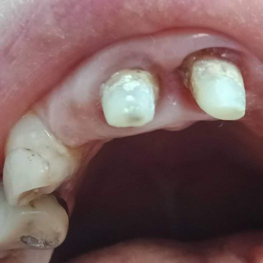 Formation sur les principes de préparation des dents en prothèse conjointe