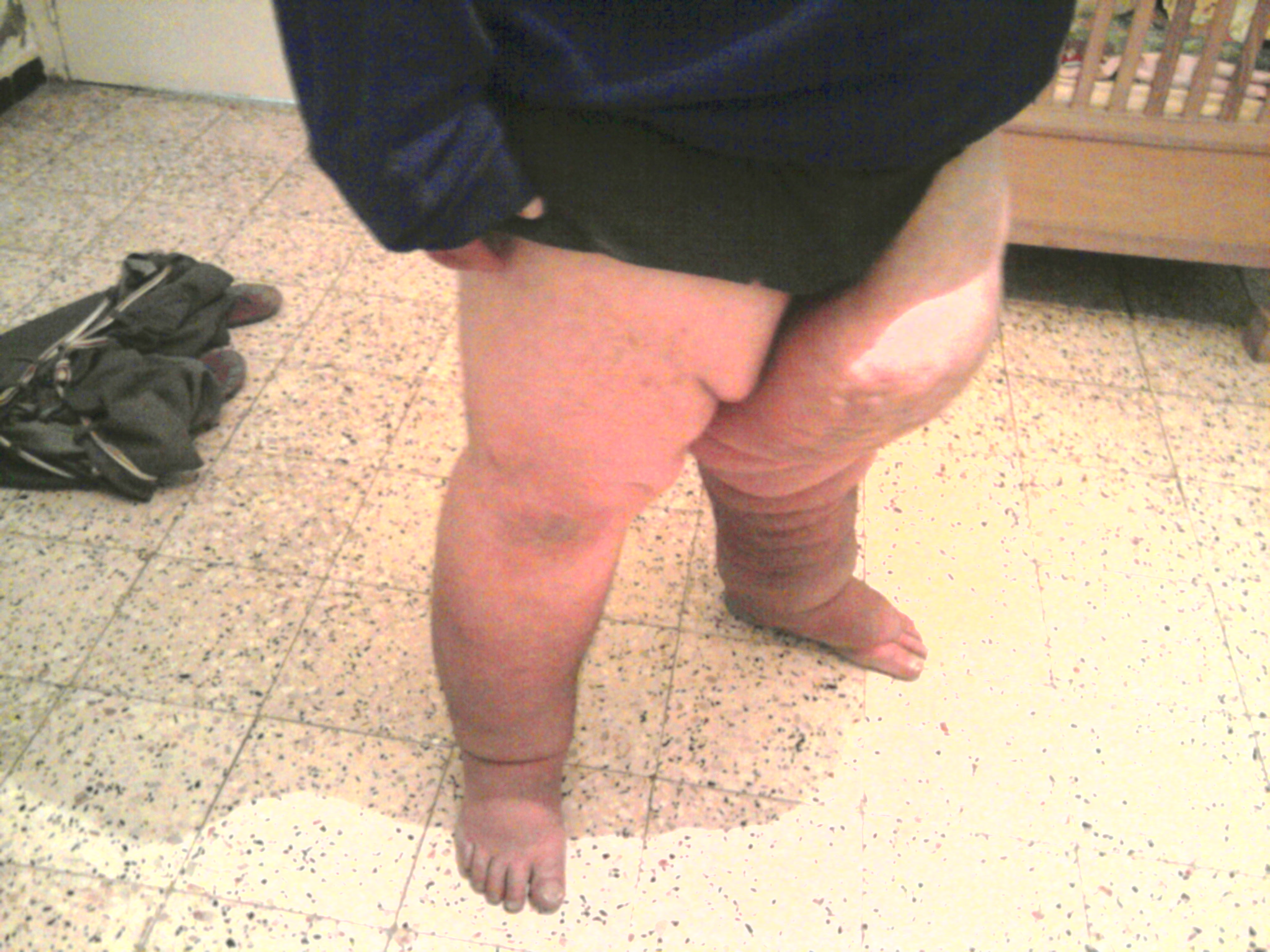 maladie rare ( ELEPHANTIASIS)