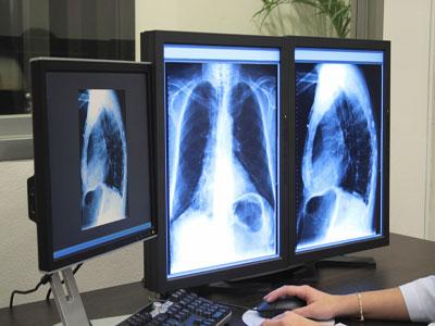 La tuberculose extra pulmonaire éclipse les autres formes Son diagnostic initial déterminant pour sa prise en charge