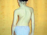 Maladie de la scoliose Plus de 350 patients sur la liste d'attente depuis 2008