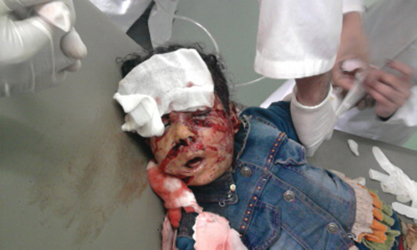 أماني تعود لعائلتها في ميلة وتنتظر المحسنين لإعادة ملامح وجهها