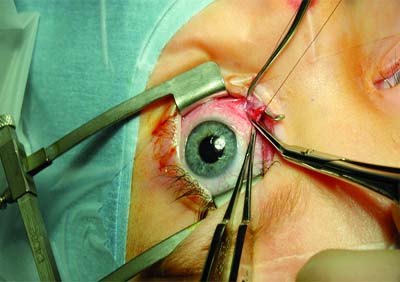 Plus de 300 greffes de la cornée réalisées en 2011