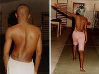 La scoliose chez l'enfant en nette progression : 355 cas recensés en milieu scolaire