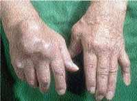 Maladies rhumatismales sous-diagnostiquées : Les patients finissent handicapés