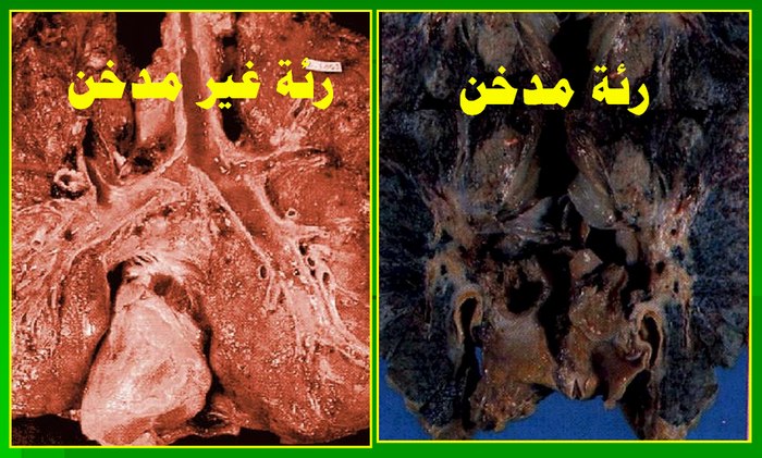 إذا كنت مدخناً فانظر إلى رئتيك