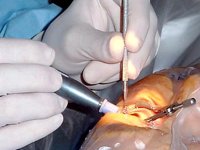 L'arrêt de l'importation de greffons à l'origine du recul de la greffe de la cornée en Algérie