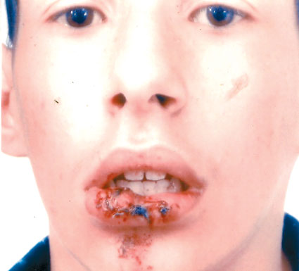 تيبازة                    أستاذ يحطم فك تلميذ في السنة الثانية متوسط