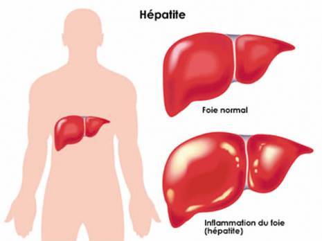 Alerte aux hépatites virales