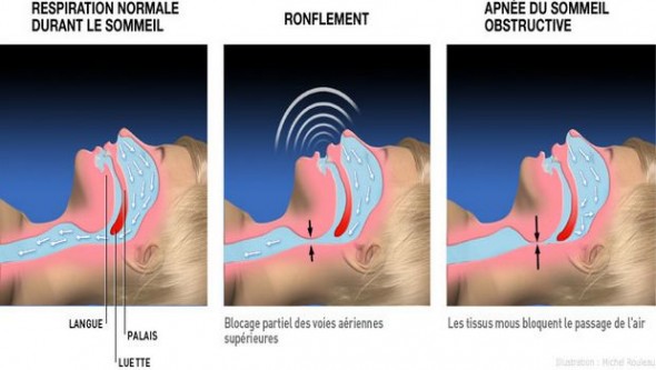 Le syndrome d'apnée du sommeil peut entraîner des complications cardiovasculaires
