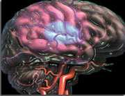 AVC : ne plus réduire la pression artérielle à la phase aiguë ?