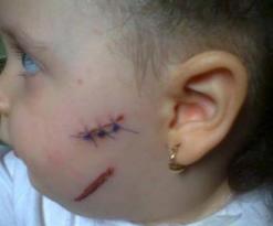 شاب يشوه وجه رضيعة بسكين في عنابة