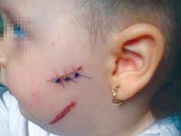 Le bébé de 2 ans avait été balafré
