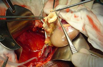 Transplantation rénale