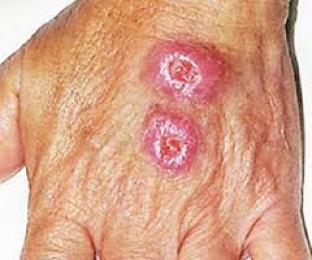 لجنة خاصة في النعامة للوقوف على الليشمانيا