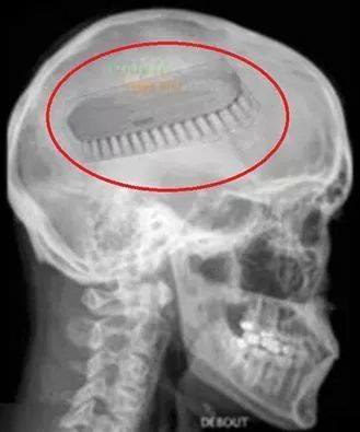 La décérébration a porté ses fruits