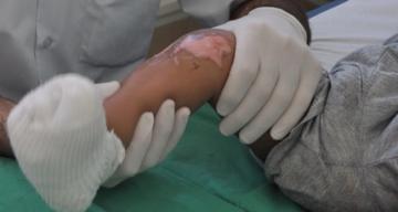 إصابة رضيع بحروق في انفجار للغاز بباتنة