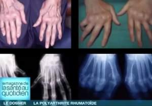 Entretien avec le Dr Salah-Eddine Kaddem. La polyarthrite rhumatoïde : de nouvelles révolutions thérapeutiques