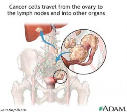 اختبار جديد للكشف عن سرطان المبيض بدقة 90 بالمائة