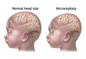 La microcéphalie
