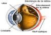 Décollement de la rétine : Une maladie mal soignée