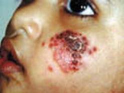 الخبراء يعرضون أبحاثهم حول داء الليشمانيوز بالمدن               تسجيل أزيد من 300 إصابة في تيزي وزو وسعيدة