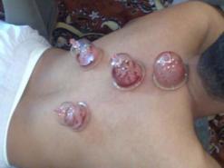 تستعمل كعلاج للأمراض ولإبطال السحر رغم ماتشكله من مخاطر              انتشار واسع لظاهرة الحجامة في ولاية تيبازة