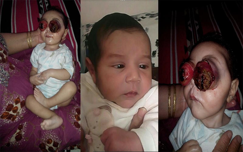 وزير الصحة يتكفل بحالة الرضيع ابراهيم مؤيد جبار الفاقد لعينيه بتاجنانت في ميلة