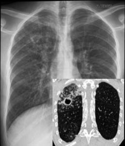 Oran - La maladie fait toujours des victimes: Une campagne contre la tuberculose