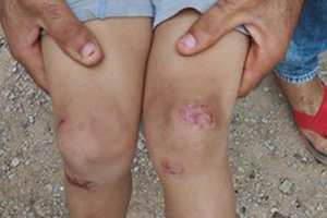 مرض جلدي غريب يصيب أطفال قرية  الحجاجرة  في معسكر