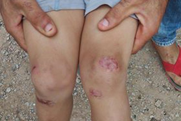 مرض جلدي غريب يصيب أطفال قرية 