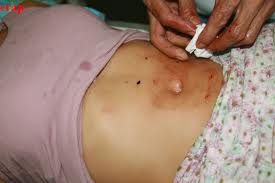 ممرض بعين فراح