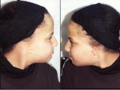 نبيلة ذات ال13 ربيعا ولدت من دون أذنين.. تطلب المساعدة