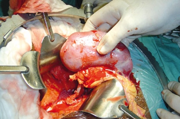 Cent six greffes rénales réalisées par le CHU de Batna