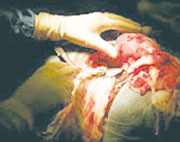 Oran : on lui vole un rein dans une clinique privée