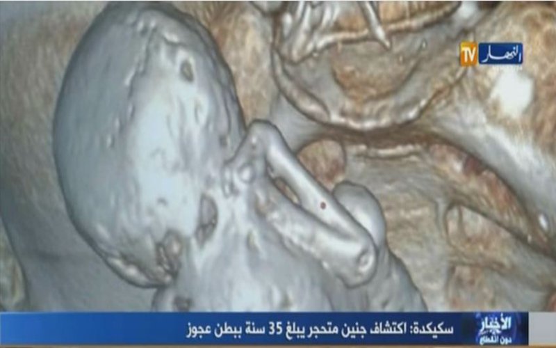 بالفيديو ...إكتشاف جنين متحجر لمدة 35 سنة ببطن عجوز بسكيكدة
