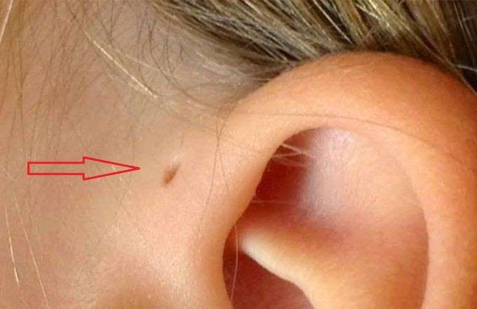 سبب وجود الثقب الذي نراه خلف اذن البعض