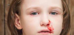 ما أسباب الرعاف عند الاطفال