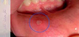 علاج فطريات الفم للأطفال