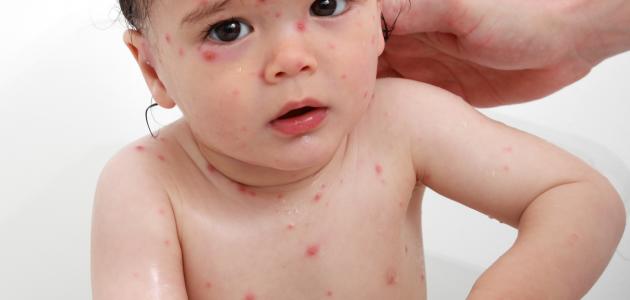 ما هو جدري الماء