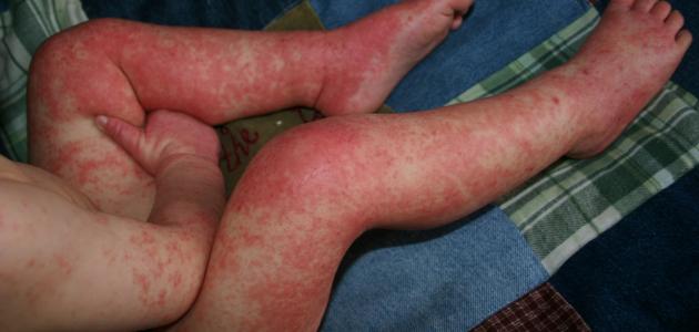 ما أسباب الطفح الجلدي عند الاطفال