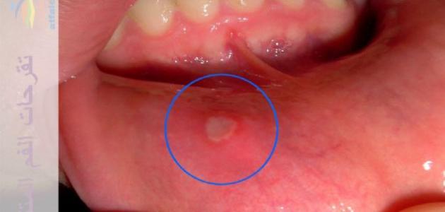 علاج فطريات الفم للأطفال