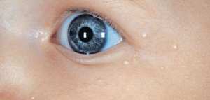 ظهور بقع بيضاء في الوجه عند الأطفال