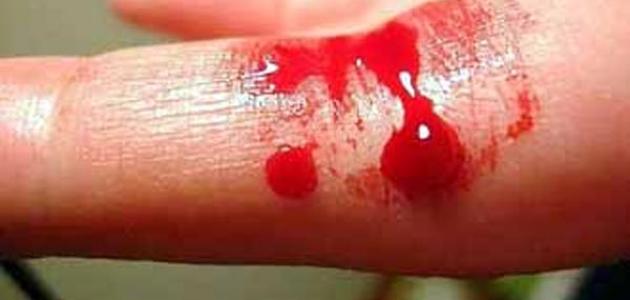 ما هي أعراض سيولة الدم