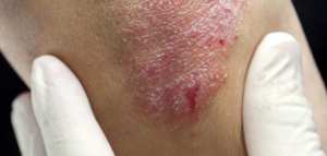 أسباب مرض الصدفية