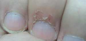 تقشر جلد الأصابع