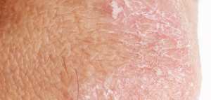 علاج الاكزيما