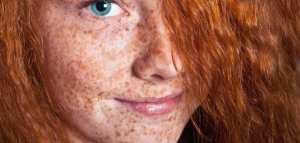 ما هو النمش