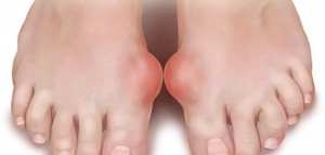 ما هو النقرس وعلاجه