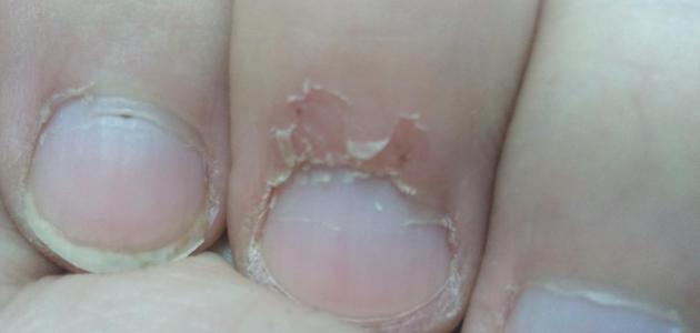 تقشر جلد الأصابع